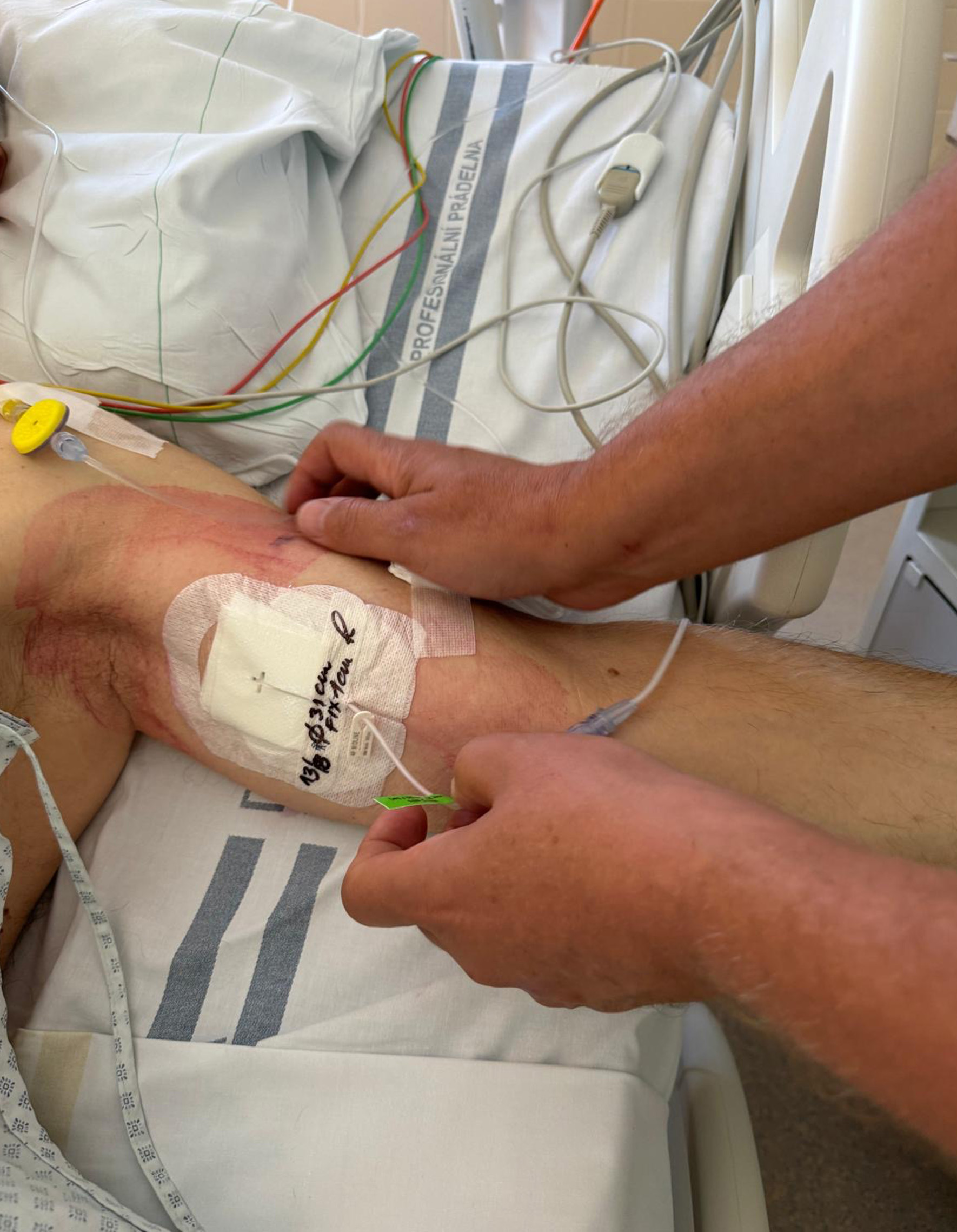 Zdravotníci nově pomůžou pacientům, které trápí rozpíchané žíly